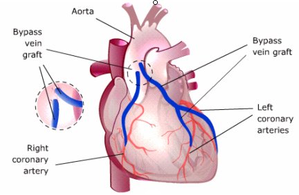 coronary artery bypass graft